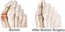 Bunion Removal Surgery NYC logo